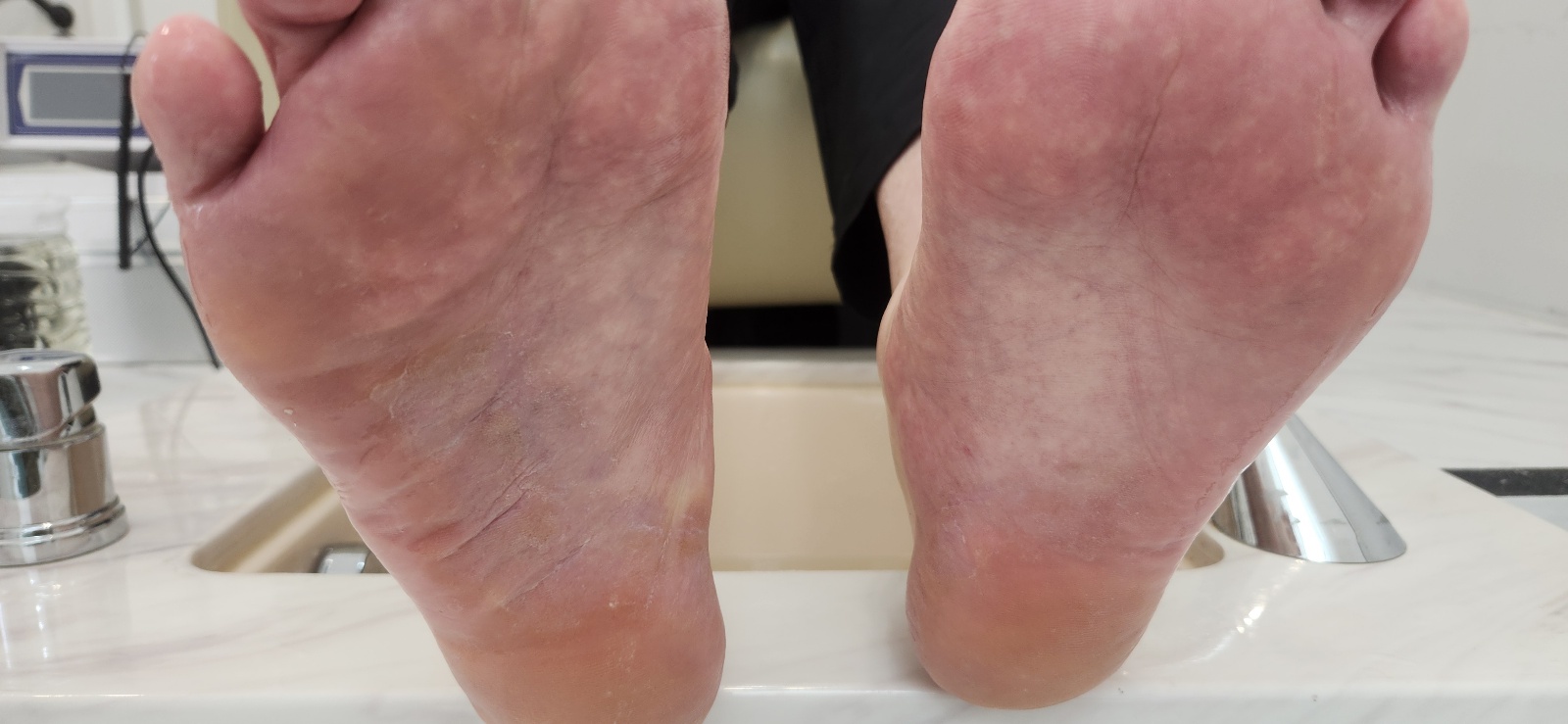 문제성 발톱 케어 전