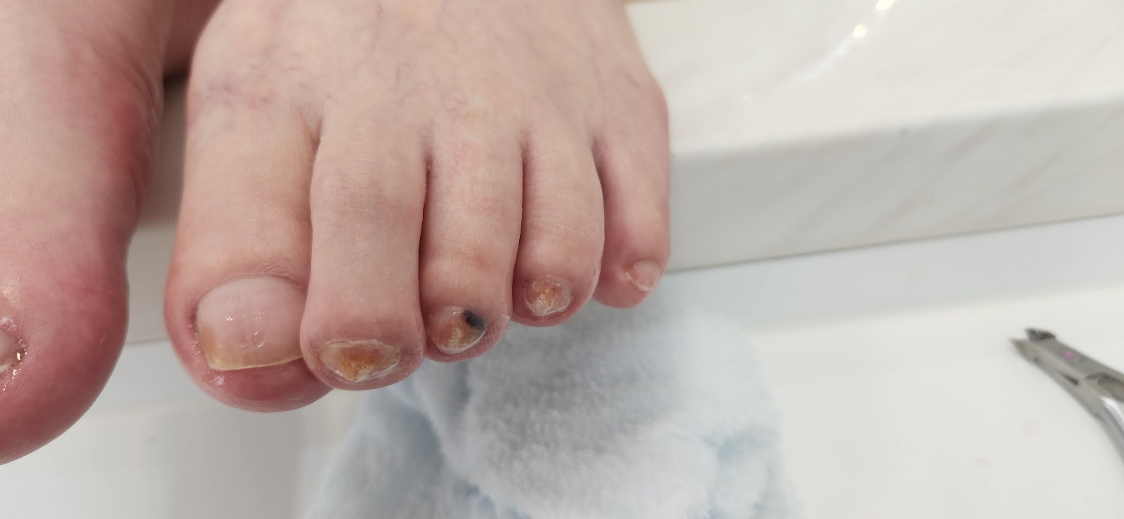 문제성 발톱 케어 후