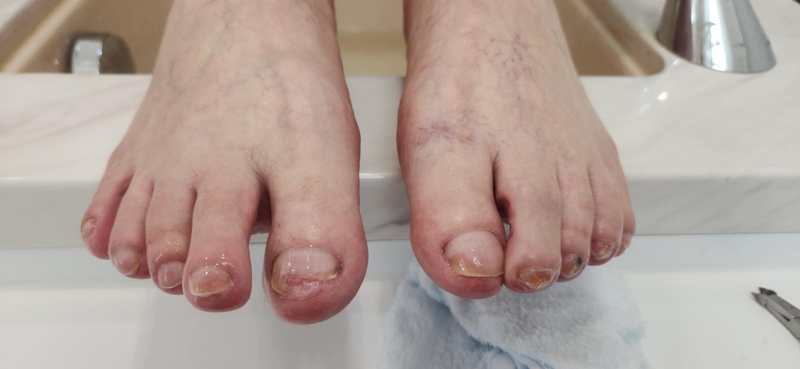 문제성 발톱 케어 후