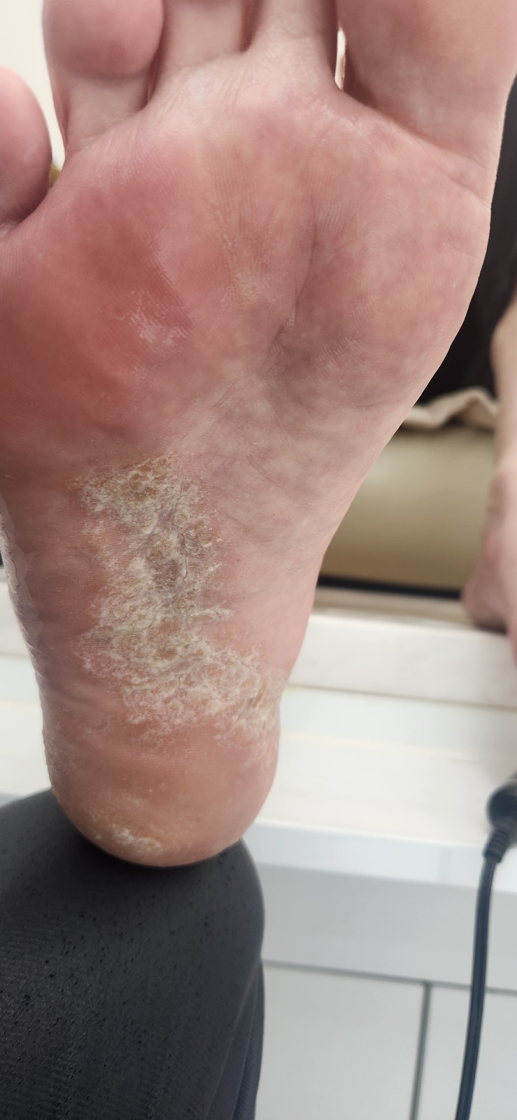 문제성 발톱 케어 전