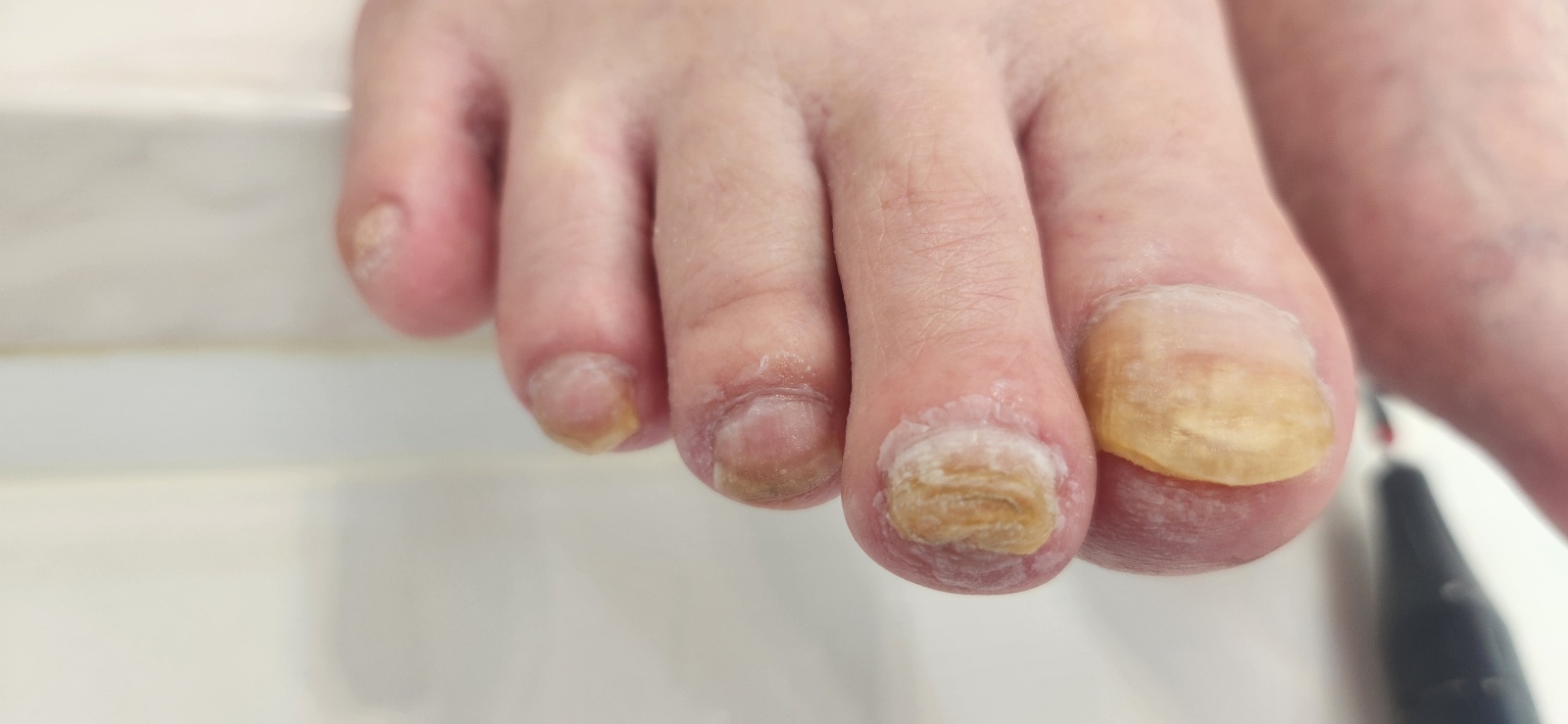 문제성 발톱 케어 후