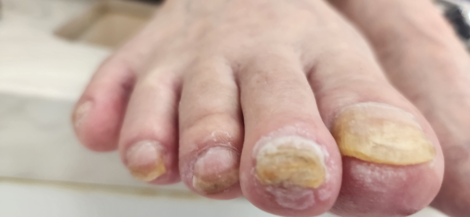 문제성 발톱 케어 전