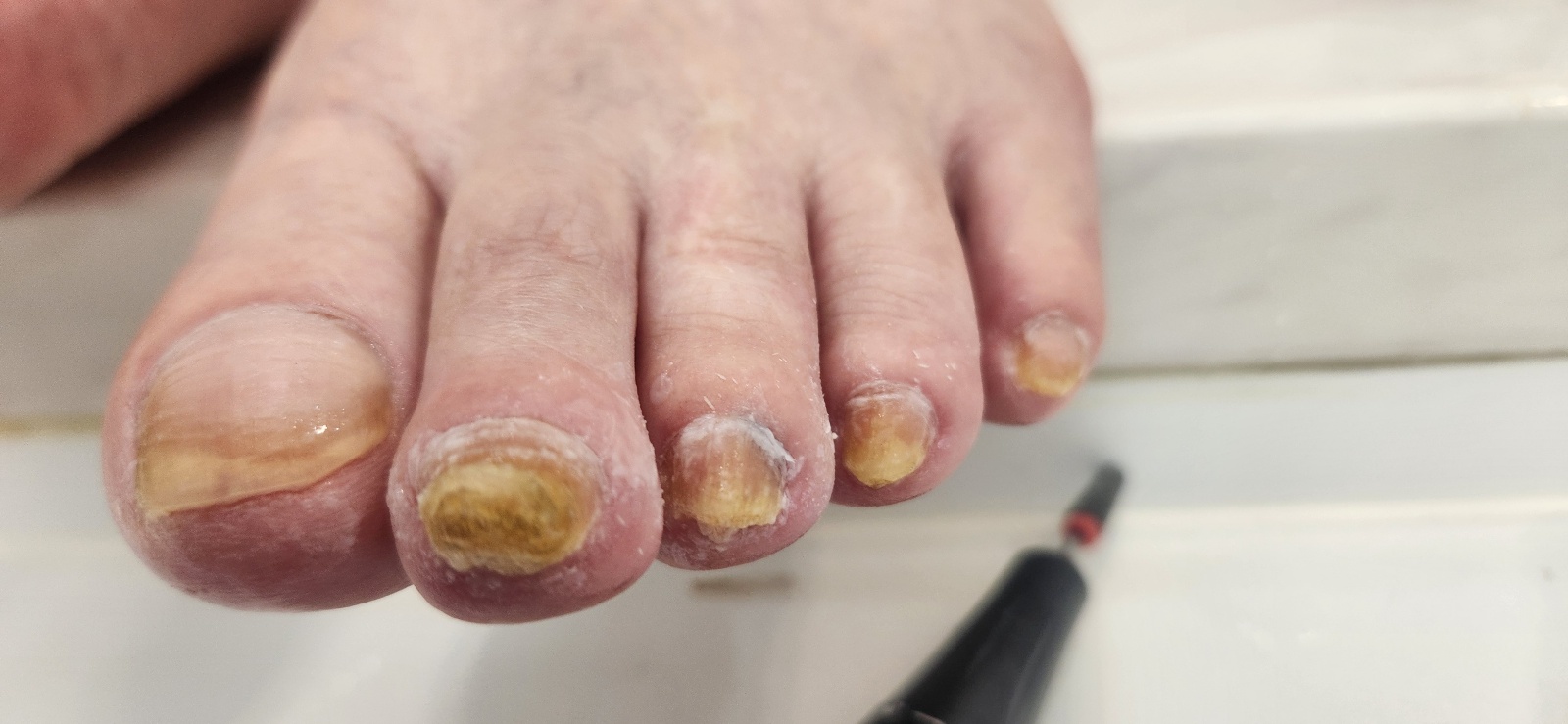 문제성 발톱 케어 후