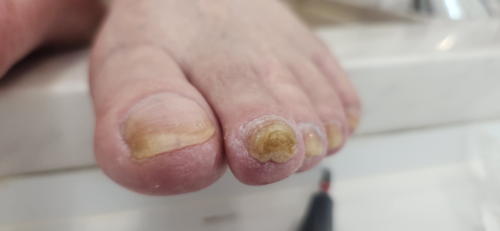 문제성 발톱 케어 전