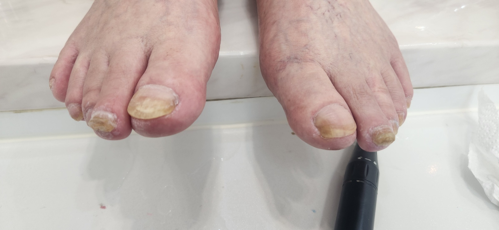 문제성 발톱 케어 후